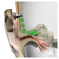 A bone-anchored hearing aid transmits sound vibrations (green waves) through the skull directly to the cochlea, shown in a detailed cross-section of the ear’s anatomy within a clinical context.