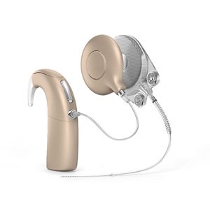 Cochlear implant device with external sound processor and implantable components.