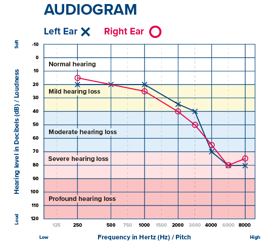 Audiogram displaying hearing levels across frequencies for left and right ears, with mild to profound hearing loss zones marked.